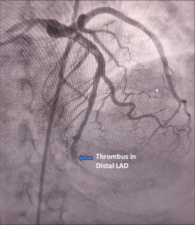 Coronary angiogram showing thrombotic occlusion in distal left anterior descending artery. The blue arrow indicates the location of the thrombotic occlusion in the distal left anterior descending artery. (LAD: Left anterior descending artery).