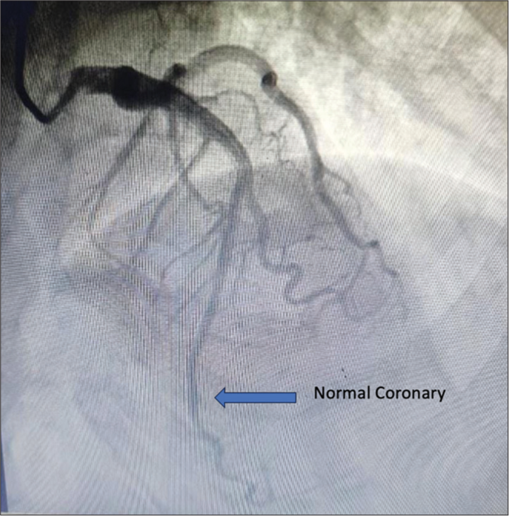 Coronary angiogram performed 15 days prior showing normal flow in distal left anterior descending artery. The blue arrow highlights the normal flow in the distal left anterior descending artery in the angiogram performed 15 days earlier.