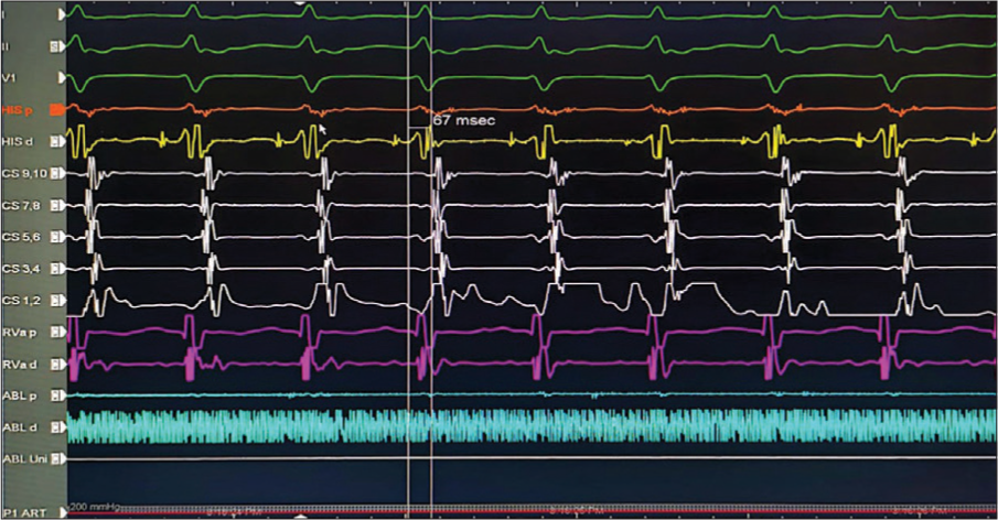 Tachycardia induction in the electrophysiological laboratory: Septal ventriculoatrial <70 ms is suggestive of typical atrioventricular nodal reentry tachycardia.