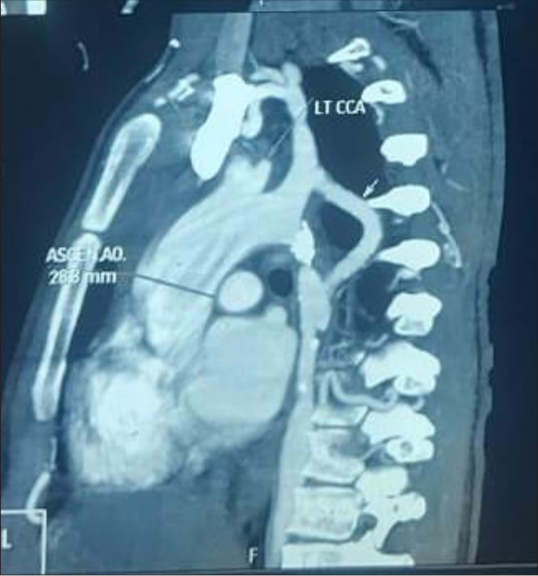Cardiac computed tomography scan showing a functioning shunt between the left subclavian artery and descending aorta. (LTCCA: Left common carotid artery, ASCEN.AO: Ascending aorta, AO: Aorta.)