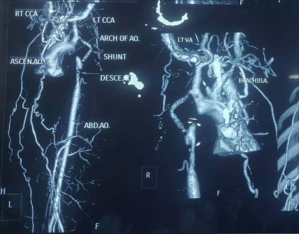 Computed tomography aortogram. (LTCCA: Left common carotid artery, ASCEN.AO: Ascending aorta, AO: Aorta, DESCE..AO: Descending aorta, ABD.AO: Abdominal aorta, VA: Vertebral artery, BRACHIOA: Brachiocephalic trunk.)