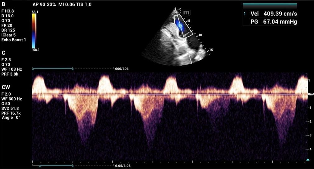 2D ECHO showing mid-left ventricular gradient. (ECHO: Echocardiography.)