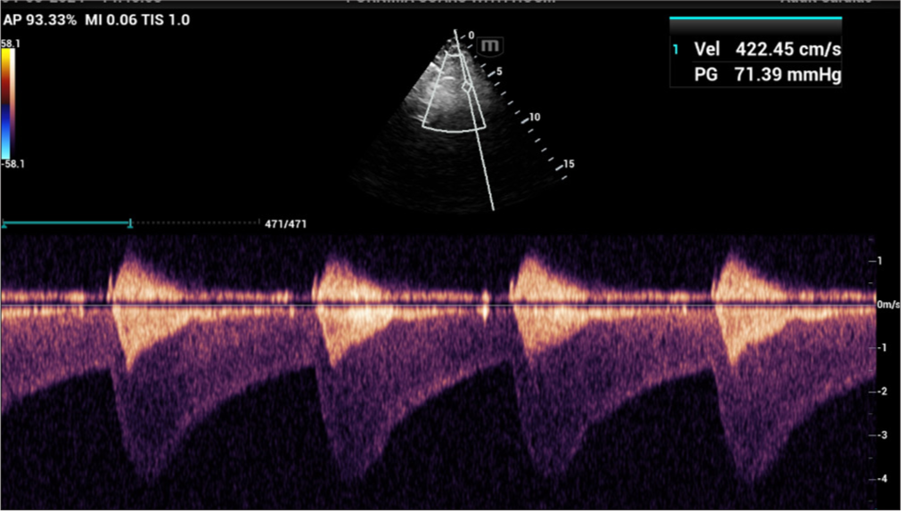 Continuous Doppler showed a sawtooth pattern with diastolic runoff.