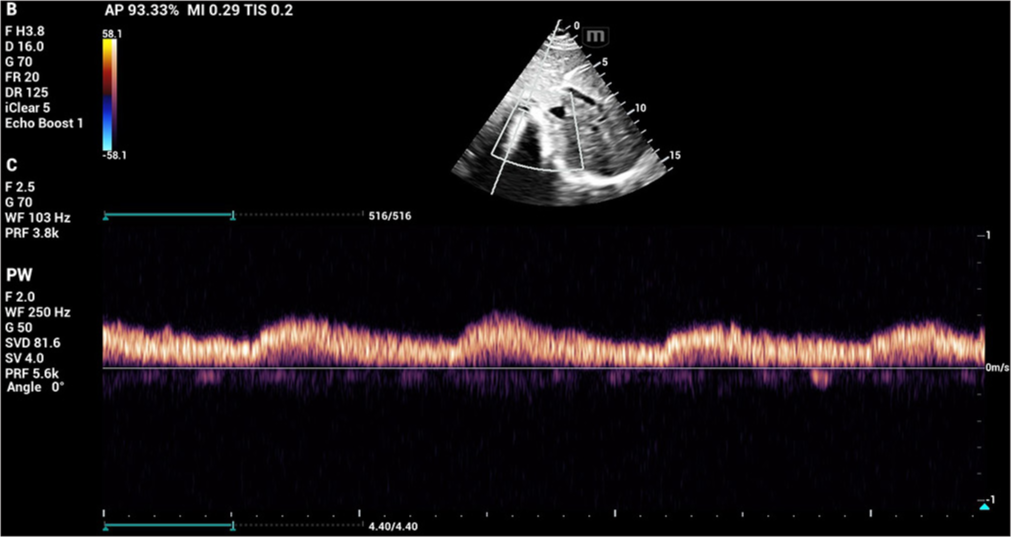 The descending aorta measured about 11 mm with low systolic amplitude and continuous flow in diastole.