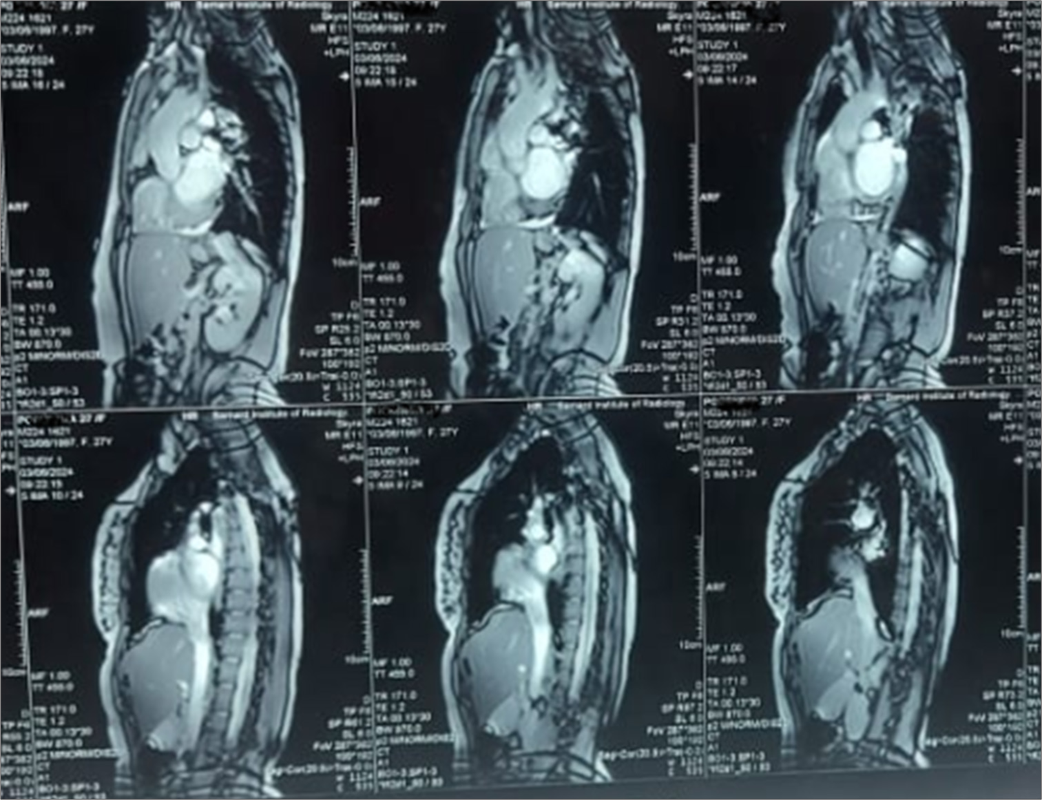 Cardiac magnetic resonance imaging showing aortic coarctation.