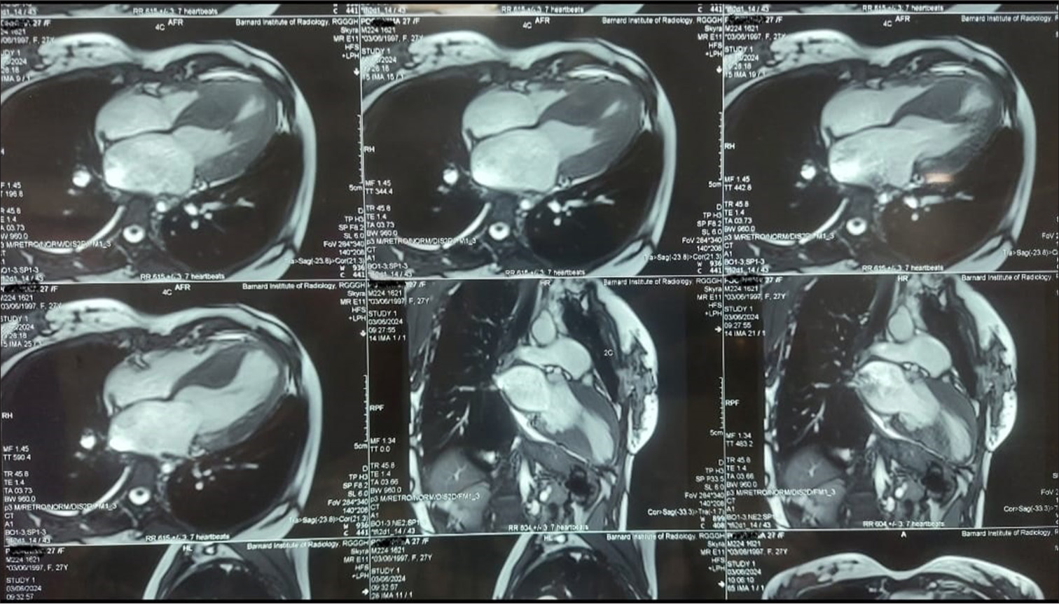 Cardiac magnetic resonance imaging showing a hypertrophied interventricular septum with a diastolic septal thickness of 2.5 cm, along with abnormal papillary muscle attachment to the left ventricular apex.