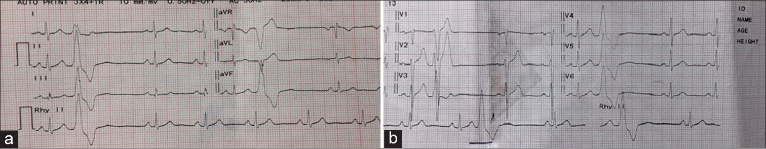 The baseline electrocardiogram (ECG) was suggestive of right ventricular outflow tract (RVOT) ventricular premature complexes (VPCs). The leads II and III were positive (inferior axis), lead I was positive (origin from right of midline), and negative lead aVL with transition lead V3 (posterior RVOT or right coronary cusp (RCC)). The QRS amplitude was more in lead II when compared to lead III. The width of 160 ms is suggestive of post-RVOT rather than RCC. The origin of VPC was localized to the posterior RVOT.