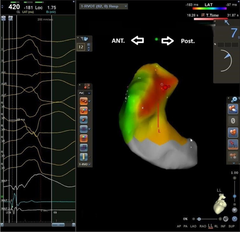 Activation map localized ventricular premature complex to the posterior right ventricular outflow tract (RVOT).