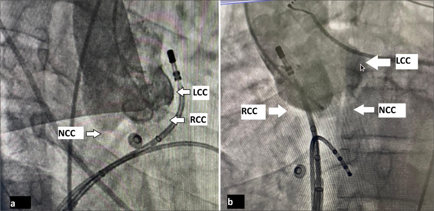 (a) Aortogram in RAO 30°. (b) Aortogram in LAO 60°. (RCC: Right coronary cusp, LCC: Left coronary cusp, NCC: Non-coronary cusp.)