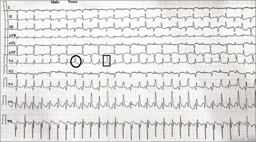 Electrocardiography after the onset of chest pain, showing narrow complex regular tachycardia. There are no p waves seen. The QRS morphology varies in the strip recorded (right bundle branch morphology [in circle] and left anterior hemiblock [in square box]) suggesting bidirectional ventricular tachycardia.