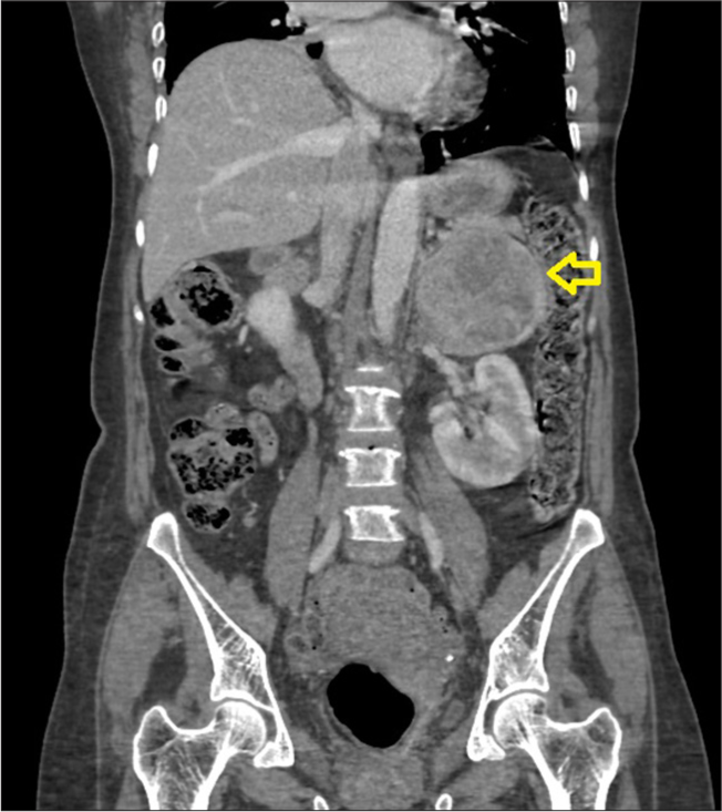 Computed Tomography of the abdomen showing a large left adrenal mass (indicated by yellow arrow).