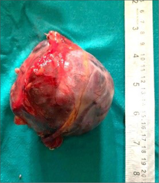 Pheochromocytoma after excision.