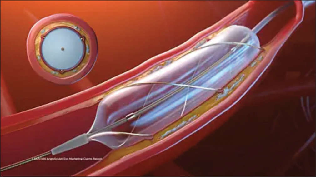 The helical nitinol scoring elements wrap the balloon circumferentially to minimize slippage and lock itself to the lesion. This scoring element can deliver up to 25 times the force of a non-compliant balloon. (AngioSculptEvoTM courtesy Philips).