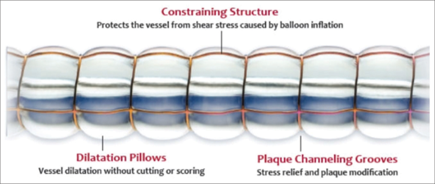 Chocolate balloonTM with advantage of its typical structure (courtesy TriReme Medical LLC, Teleflex).