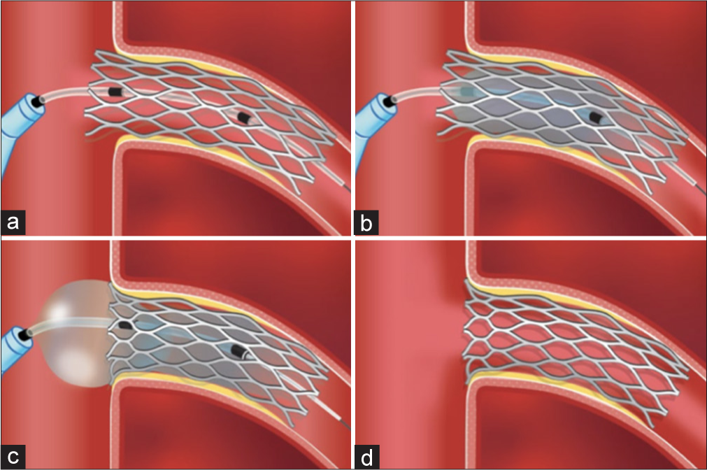 (a) the placement of markers while using an ostial flash balloon. Mid-marker: At the ostium (placed 2 mm distal to the proximal edge of the stent). Distal marker: At least 2–3 mm within the stent. Never beyond the distal edge of the stent. Proximal marker: In the aorta, outside the guide catheter. (b) The distal balloon is inflated upto desired pressure. (c) inflation of the proximal spherical balloon. (d) Deflation of proximal balloon followed by deflation of distal balloon. (coutesy Ostial Corporation [Osital]).