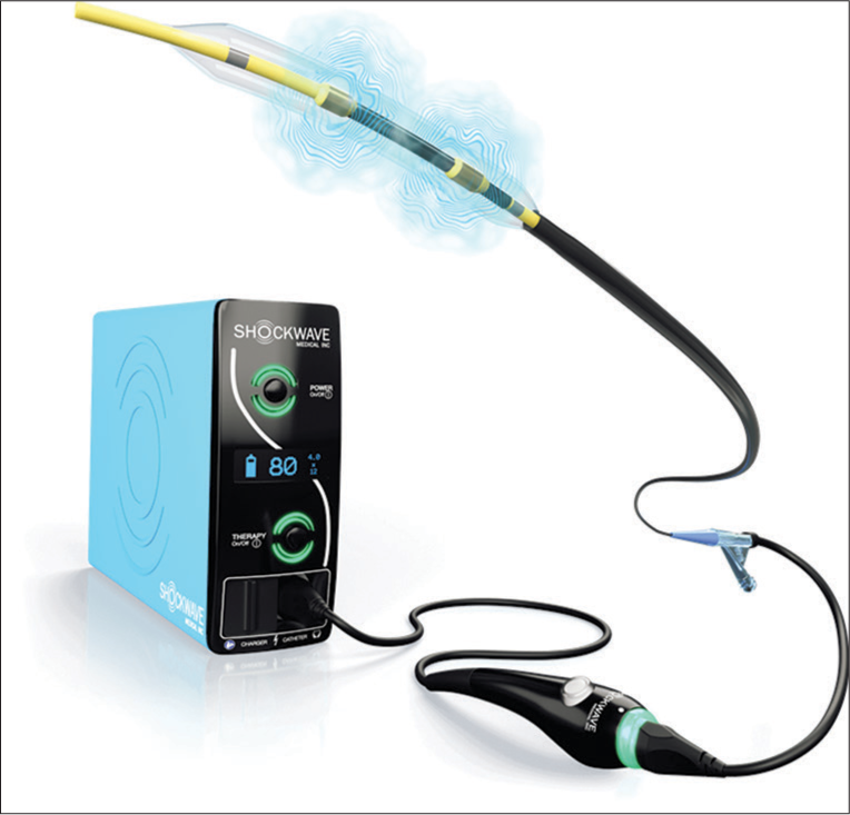 Intravascular lithotripsy balloon with console (courtesy Shockwave medicals).