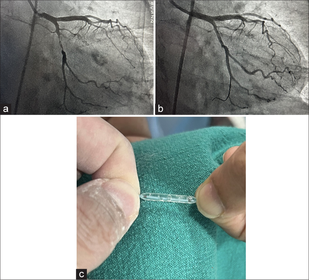 (a) Coronary angiogram before using GRIP TT (Acrostak) balloon, (b) Coronary angiogram before using GRIP TT (Acrostak) balloon, (c) Image showing the rows of focal knobs positioned across the body of the balloon. The Focal knobs act as pressure points to treat difficult to crack plaque at the same time helping the balloon to grip, reducing the risk of slippage.