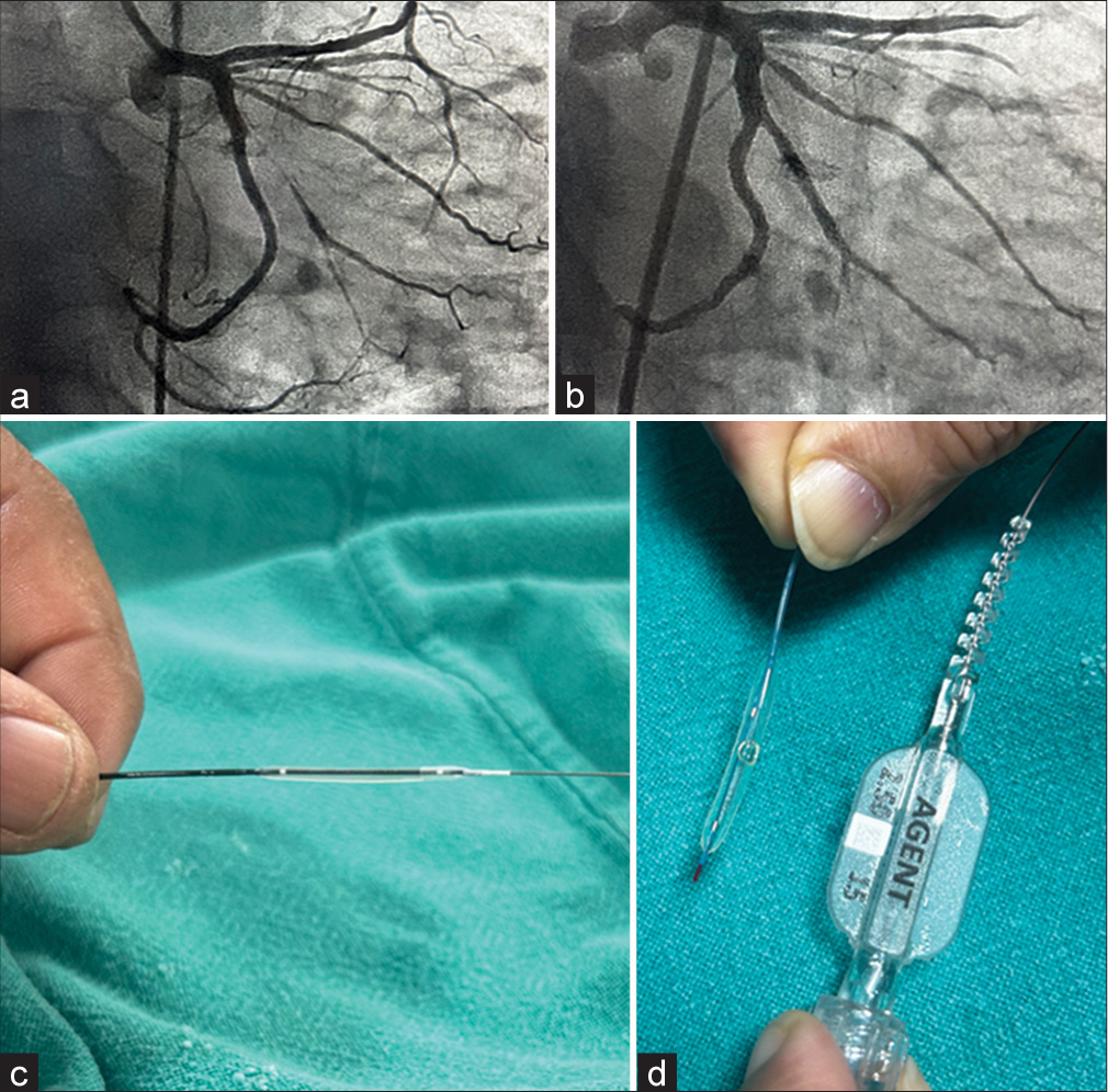 (a) Coronary angiogram before using the drug coated balloon, (b) Coronary angiogram after using drug coated balloon, (c) Sirolimus coated Magic Touch balloon, (d) Paclitaxel coated AGENT balloon.