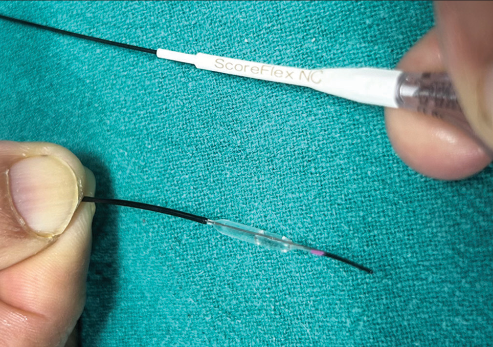 Scoreflex is a focused force dilatation balloon with a dual-wire system which creates a focal stress pattern to facilitate safe and controlled plaque modification at lower resolution pressure. The sharp edge of wire can be seen on the upper side of the balloon.