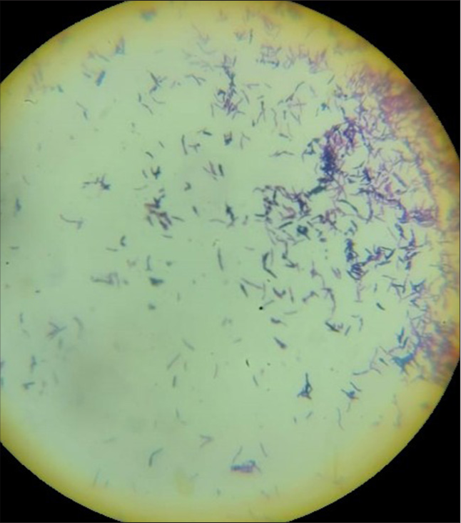 Gram stain showing Gram-positive bacilli. 100× Oil immersion