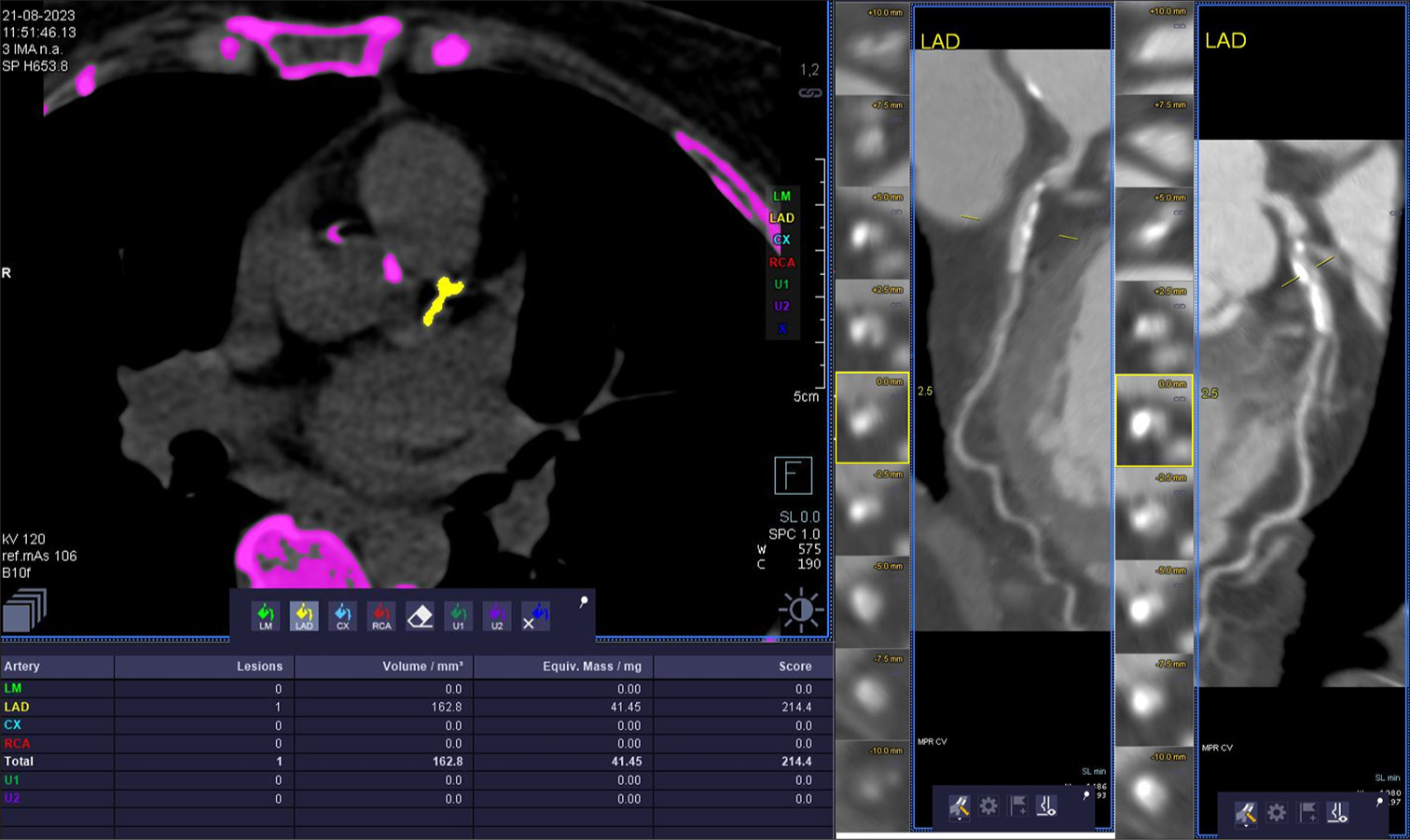 61 year-old male patient with calcium score of 131. There is no significant block on CT-coronary angiogram. He had 4 risk factors.